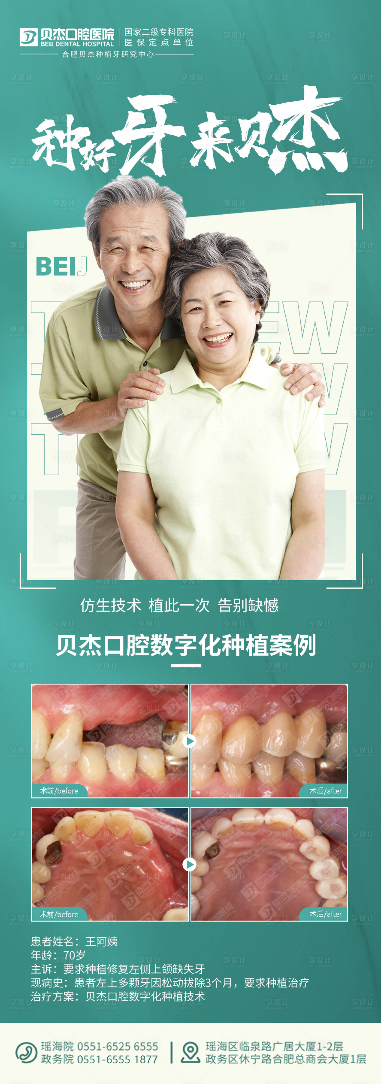 源文件下載【享設(shè)計(jì)】搜索編號(hào)：44820011166422355【種植牙牙齒長(zhǎng)圖海報(bào)】