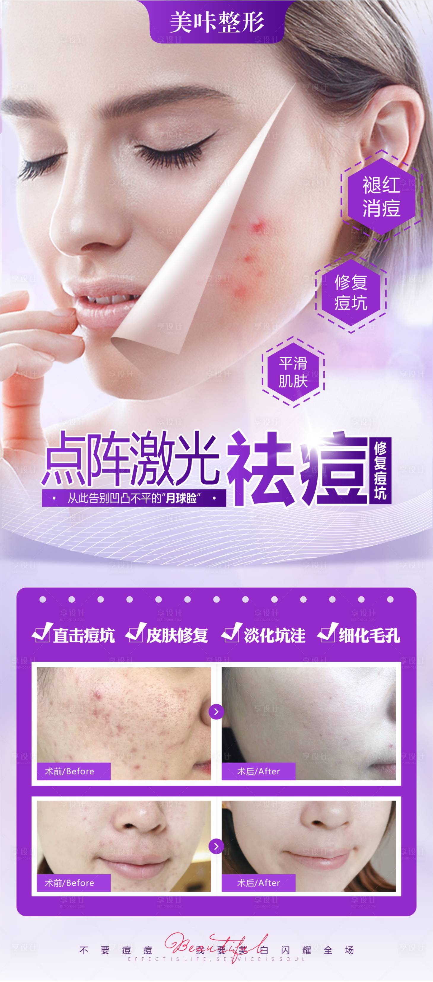 源文件下载【享设计】搜索编号：17110011085423829【祛痘宣传展架】