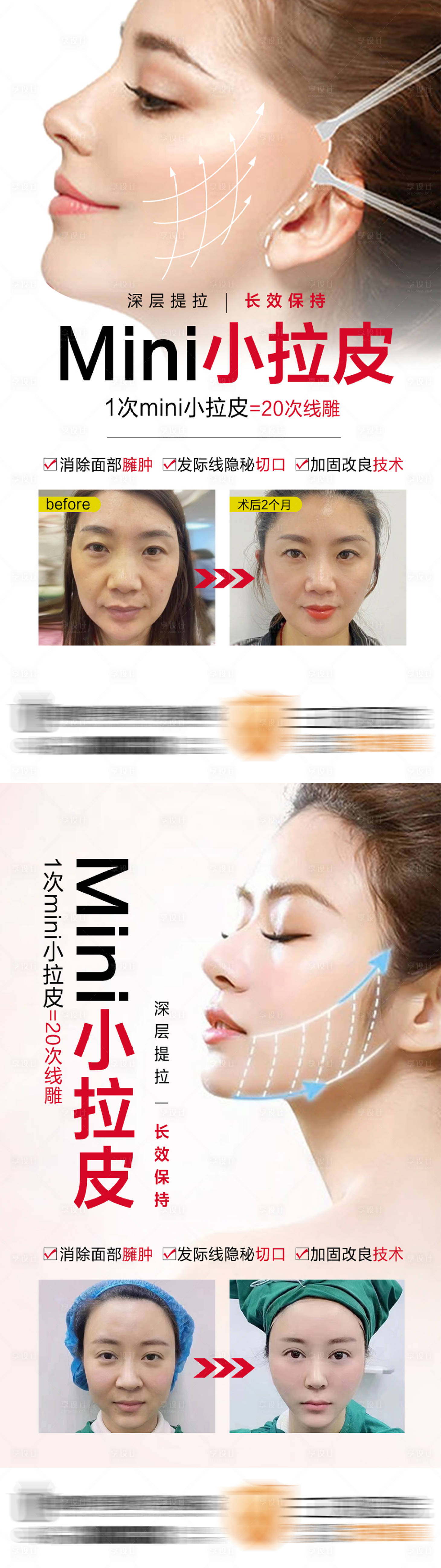 源文件下载【医美整形迷你小拉皮】编号：45870010943638966
