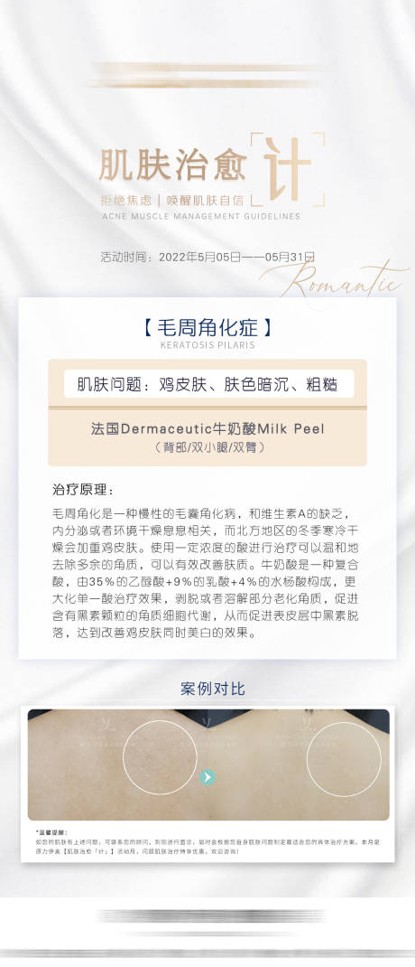 源文件下载【享设计】搜索编号：33410010877779663【医美刷酸海报】