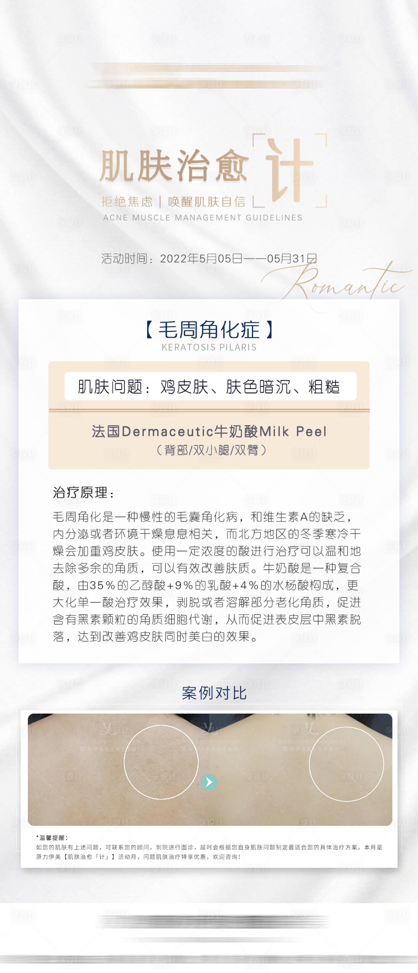 源文件下載【享設(shè)計(jì)】搜索編號(hào)：33410010877779663【醫(yī)美刷酸海報(bào)】