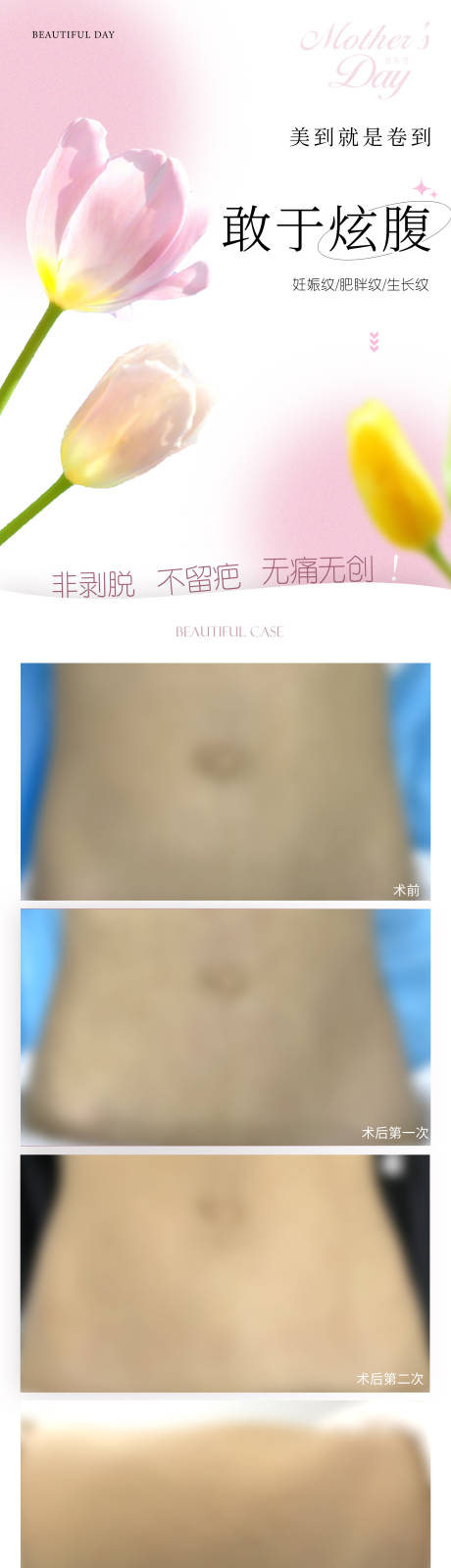 源文件下载【医美腹部妊娠纹肥胖纹生长纹长图】编号：80850010945942243