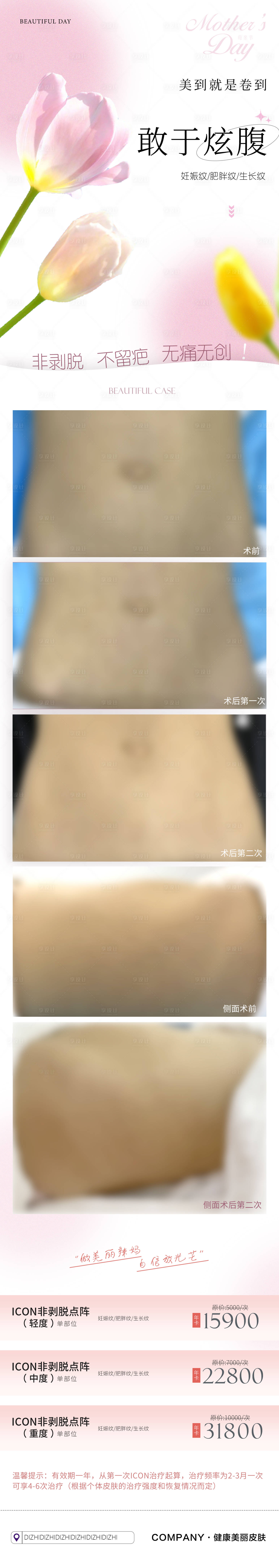 源文件下载【享设计】搜索编号：80850010945942243【医美腹部妊娠纹肥胖纹生长纹长图】