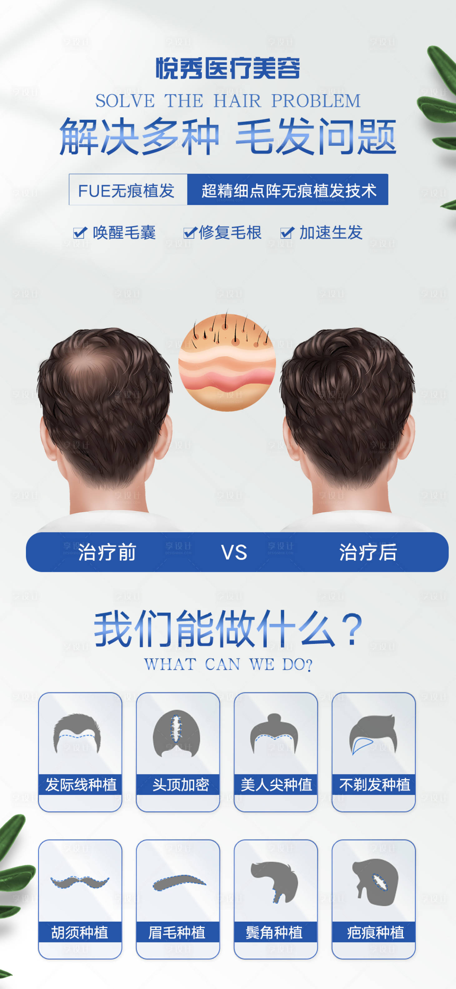 源文件下载【享设计】搜索编号：79950011371346612【医美植发案例海报】