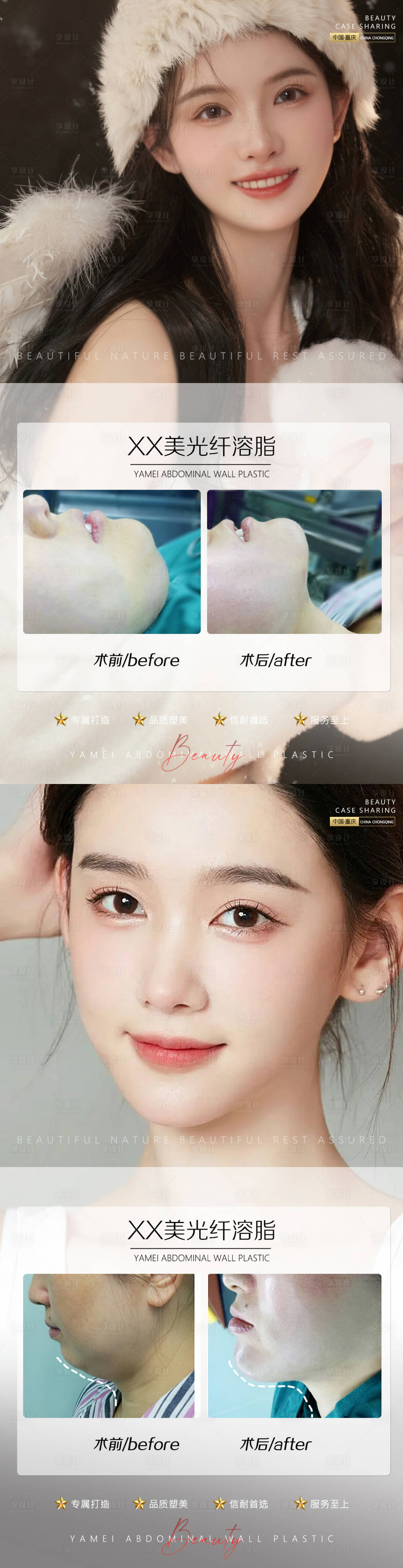 源文件下载【享设计】搜索编号：56740011654657420【医美案例光纤溶脂系列海报】