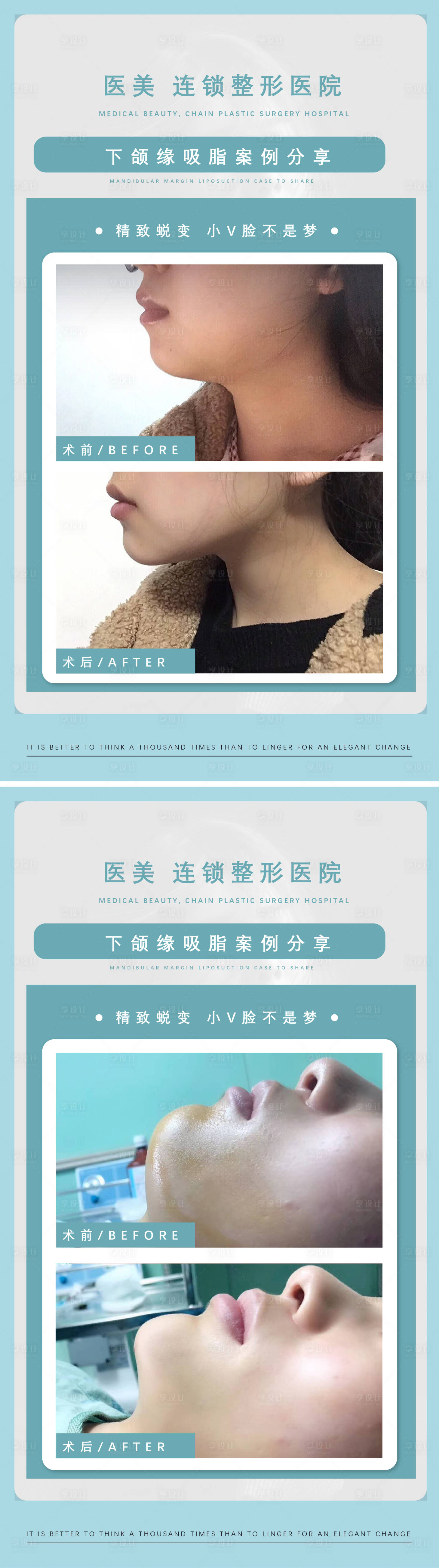 源文件下载【享设计】搜索编号：13860011769529080【医美下颌缘吸脂案例系列海报】
