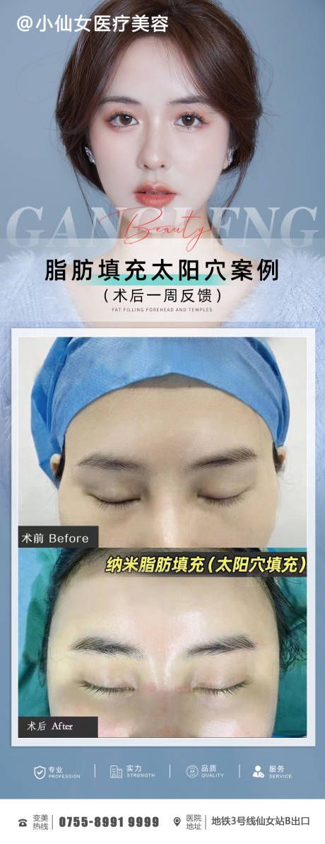 源文件下载【医美整形脂肪填充太阳穴案例】编号：43450011756537568