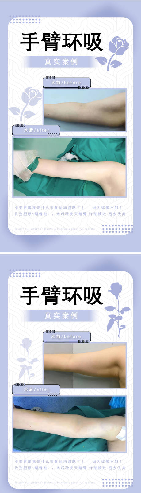 源文件下載【享設(shè)計(jì)】搜索編號(hào)：43770011855817077【醫(yī)美吸脂案例海報(bào)】