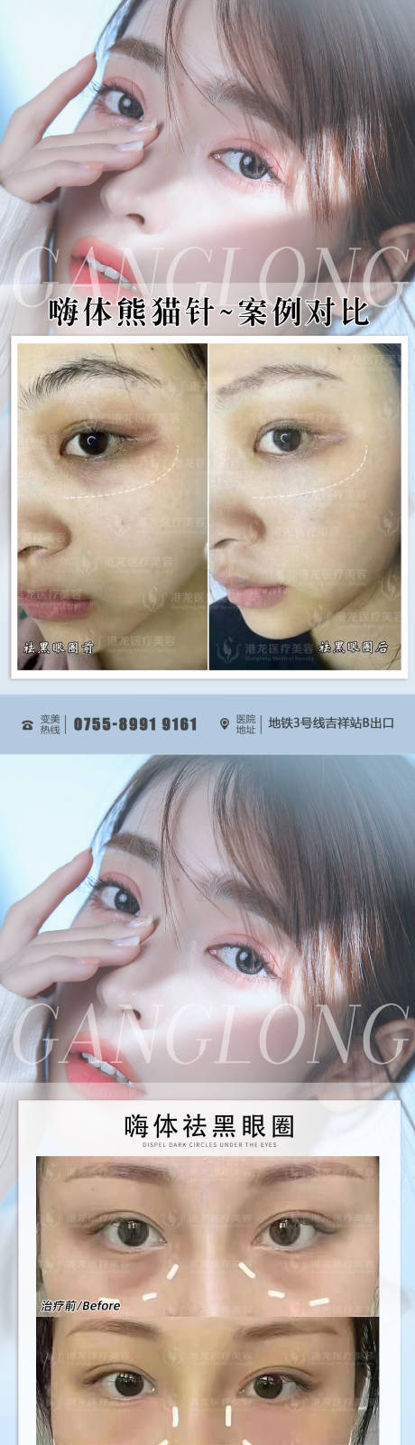 源文件下載【醫(yī)美整形嗨體熊貓針案例對比海報】編號：70340011616998073