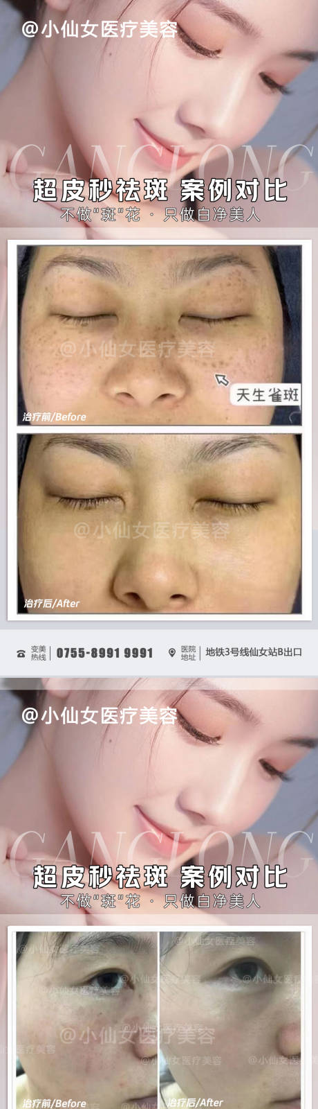 源文件下载【医美超皮秒案例对比】编号：77070011680513013