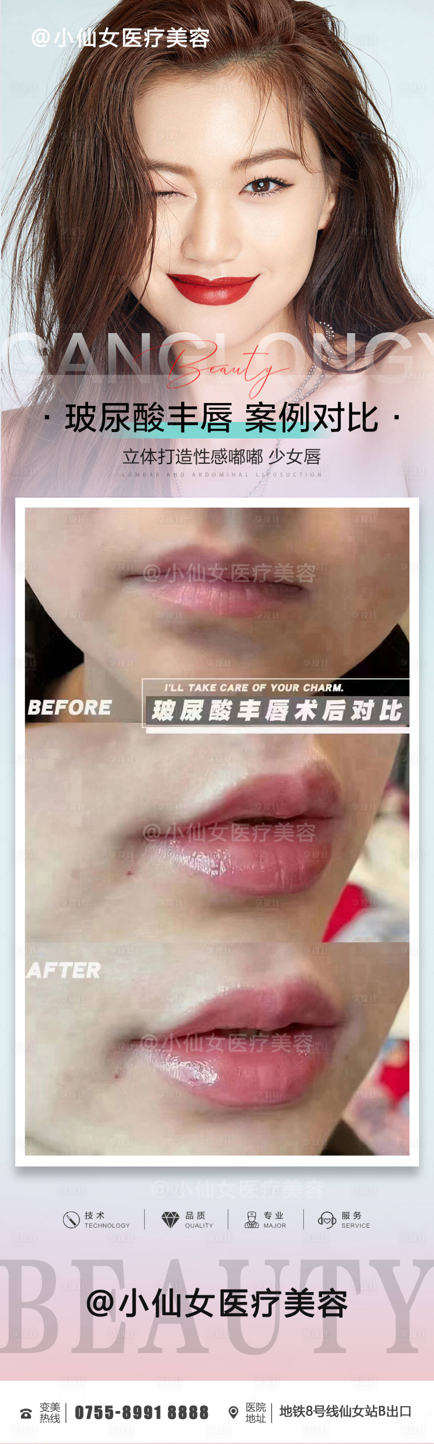 源文件下載【醫美整形玻尿酸豐唇案例海報】編號：22260011806788431