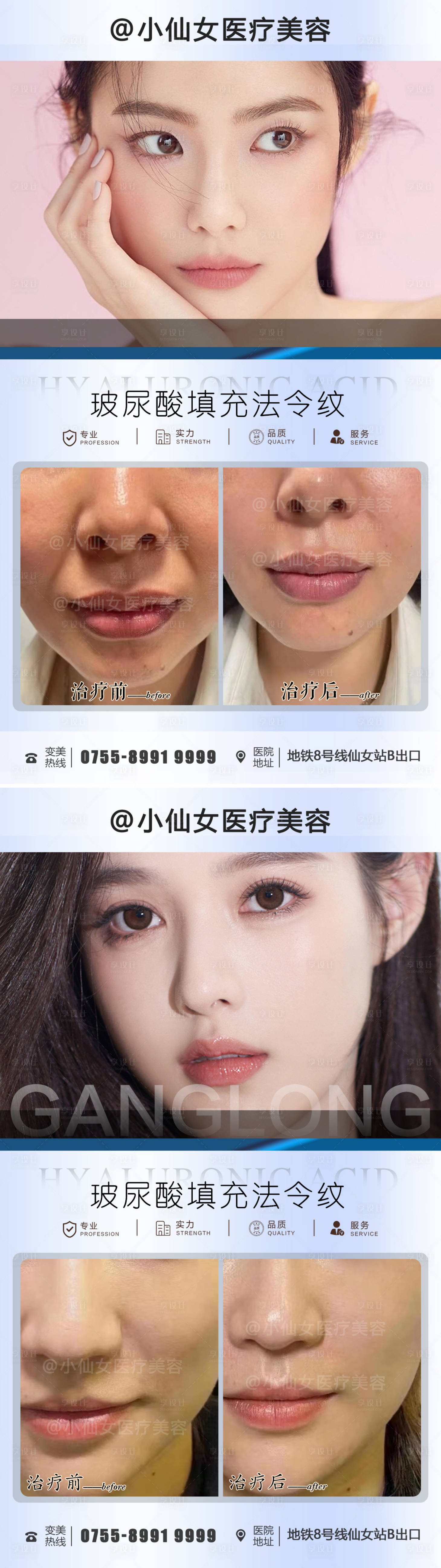 源文件下载【玻尿酸填充案例海报】编号：81860011656583613