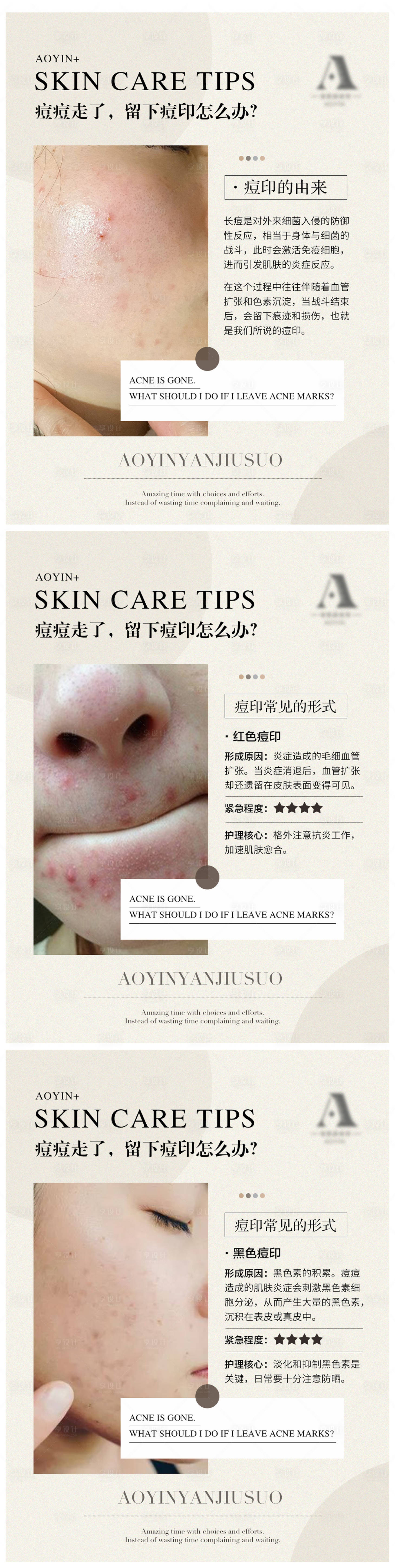 源文件下载【享设计】搜索编号：90280011657234138【痘印由来与分类常识干货分享系列海报】