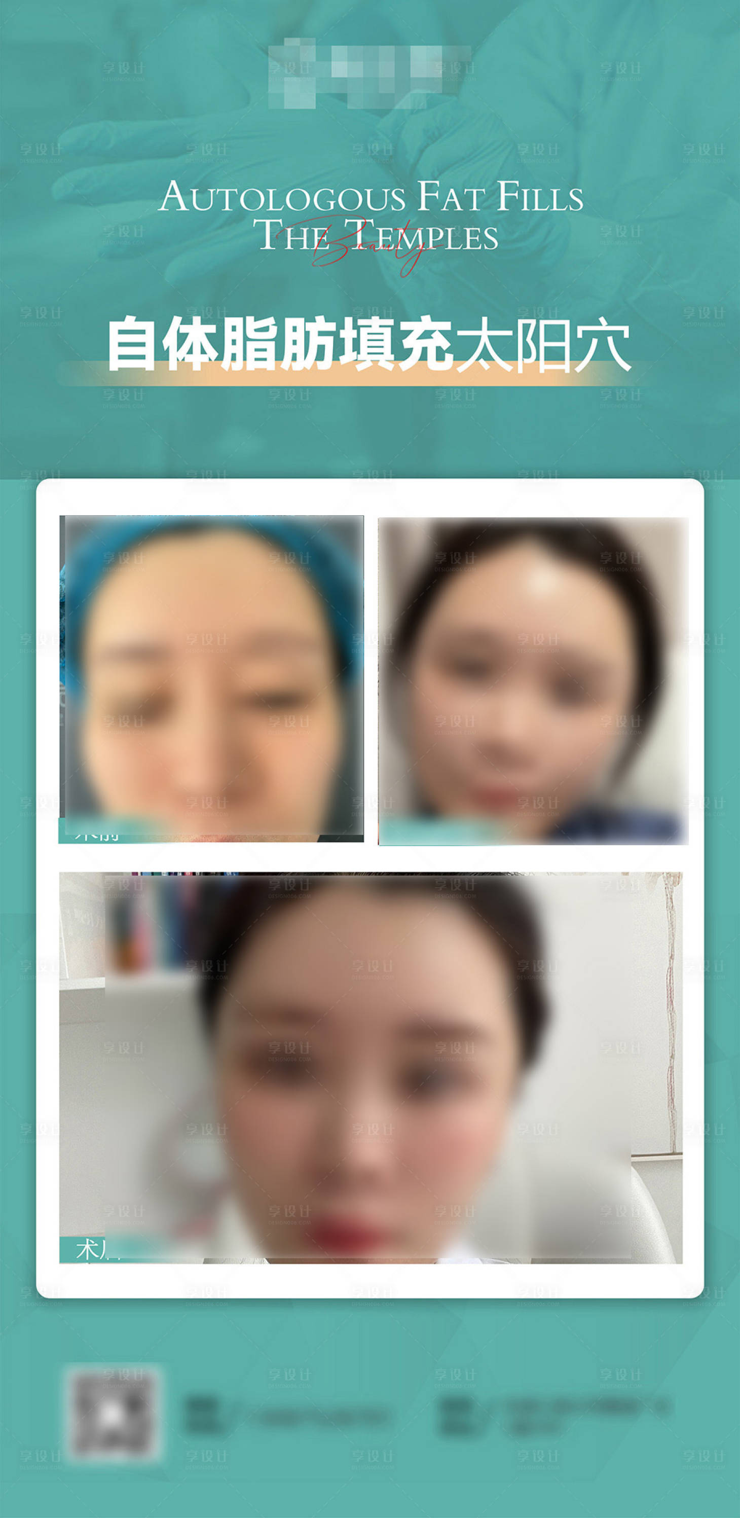源文件下載【享設計】搜索編號：66800009125445515【醫(yī)美脂肪填充案例對比】