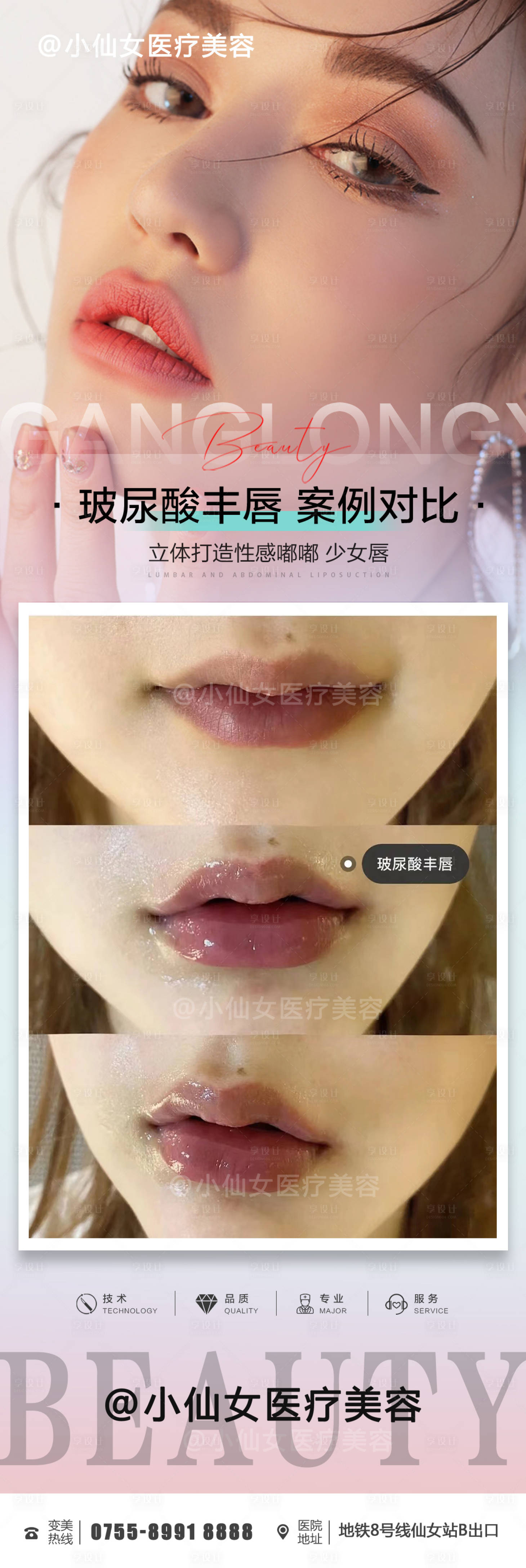 源文件下载【医美整形玻尿酸丰唇案例海报】编号：84230011988272118