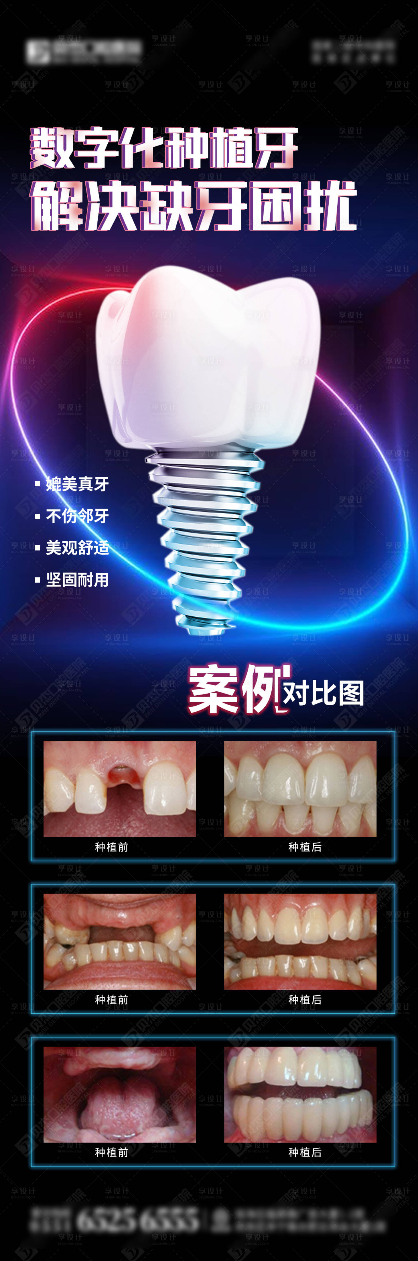 源文件下载【享设计】搜索编号：41260012100426109【数字化种植牙案例】