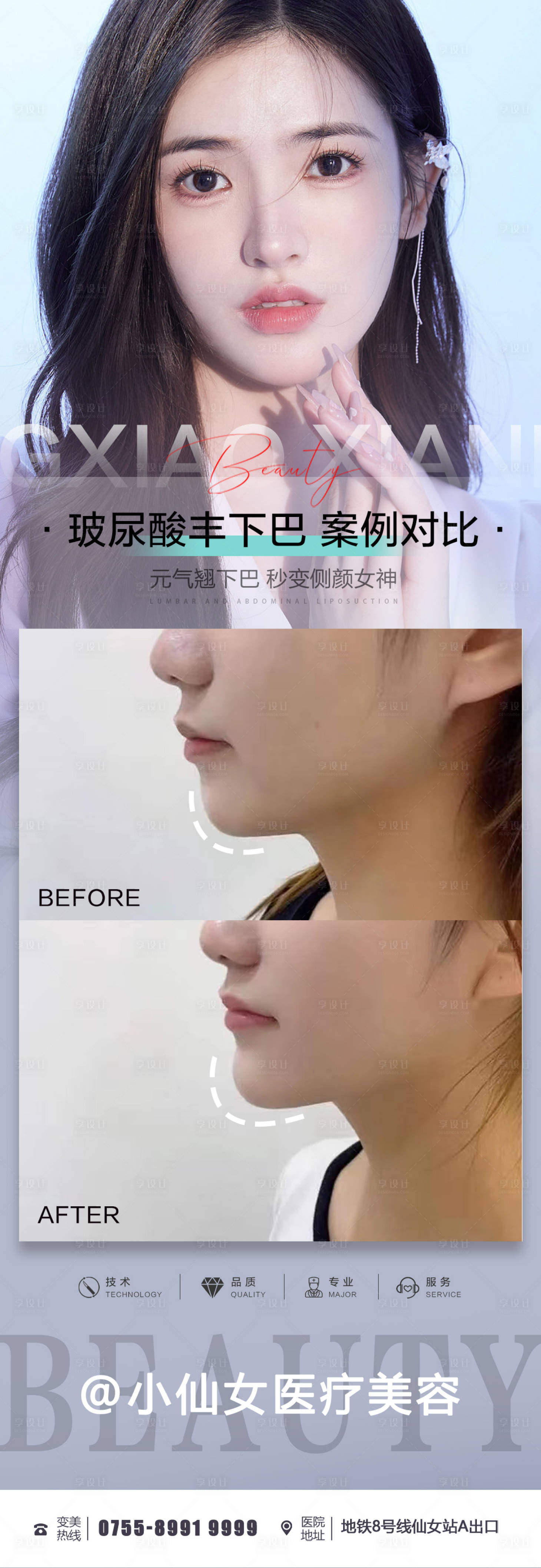 源文件下載【享設(shè)計(jì)】搜索編號(hào)：68630012203403180【醫(yī)美微整玻尿酸豐下巴案例】
