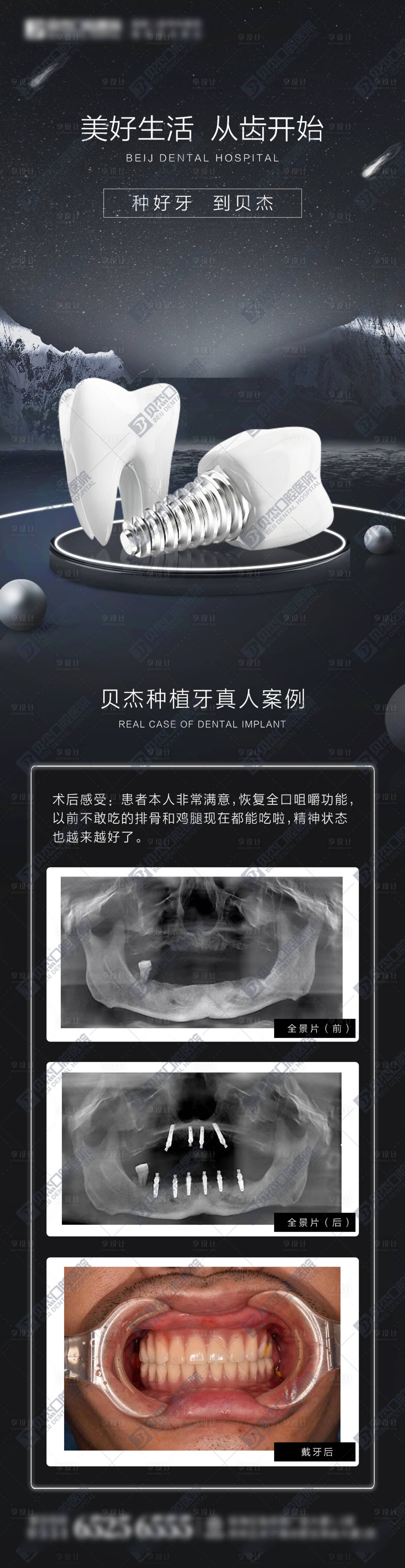 源文件下载【享设计】搜索编号：80420012100678497【种植牙案例】