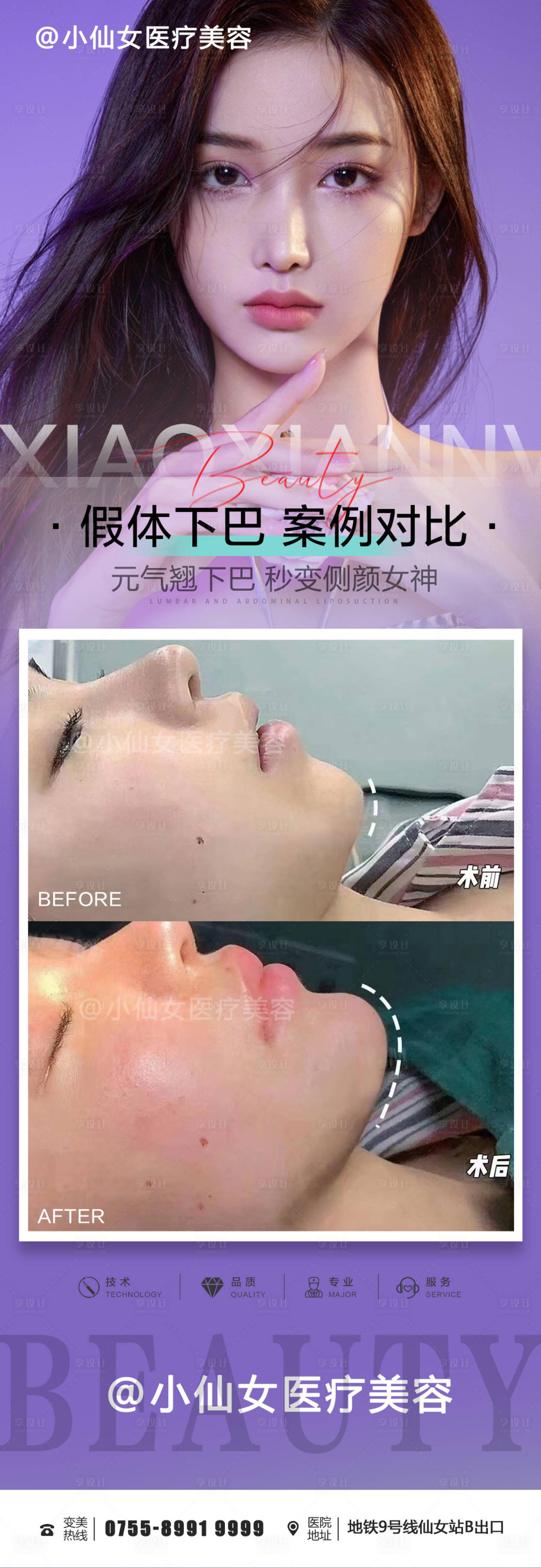 源文件下载【医美整形假体丰下巴案例】编号：94470012333284150