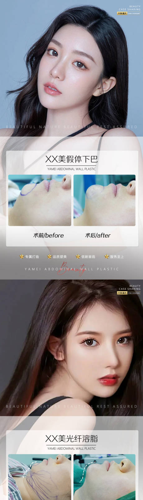 源文件下载【享设计】搜索编号：37250012102821041【医美案例假体下巴 】