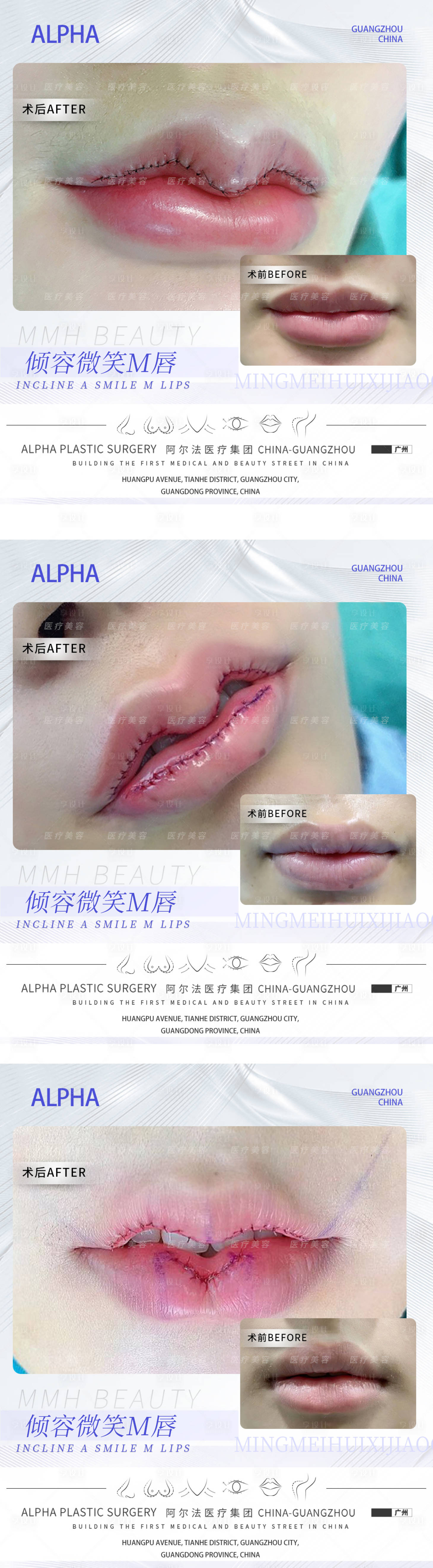 源文件下载【享设计】搜索编号：70440012259844933【医美M唇案例】