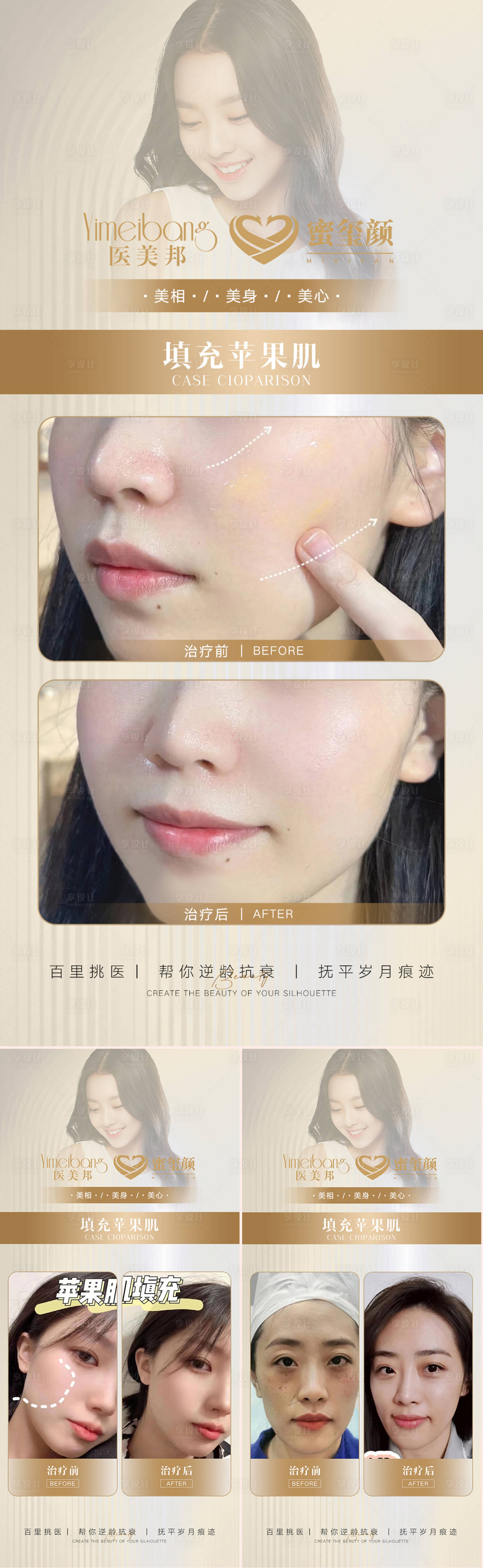 源文件下載【享設(shè)計(jì)】搜索編號(hào)：56680012394743761【醫(yī)美蘋(píng)果肌案例對(duì)比圖系列海報(bào)】