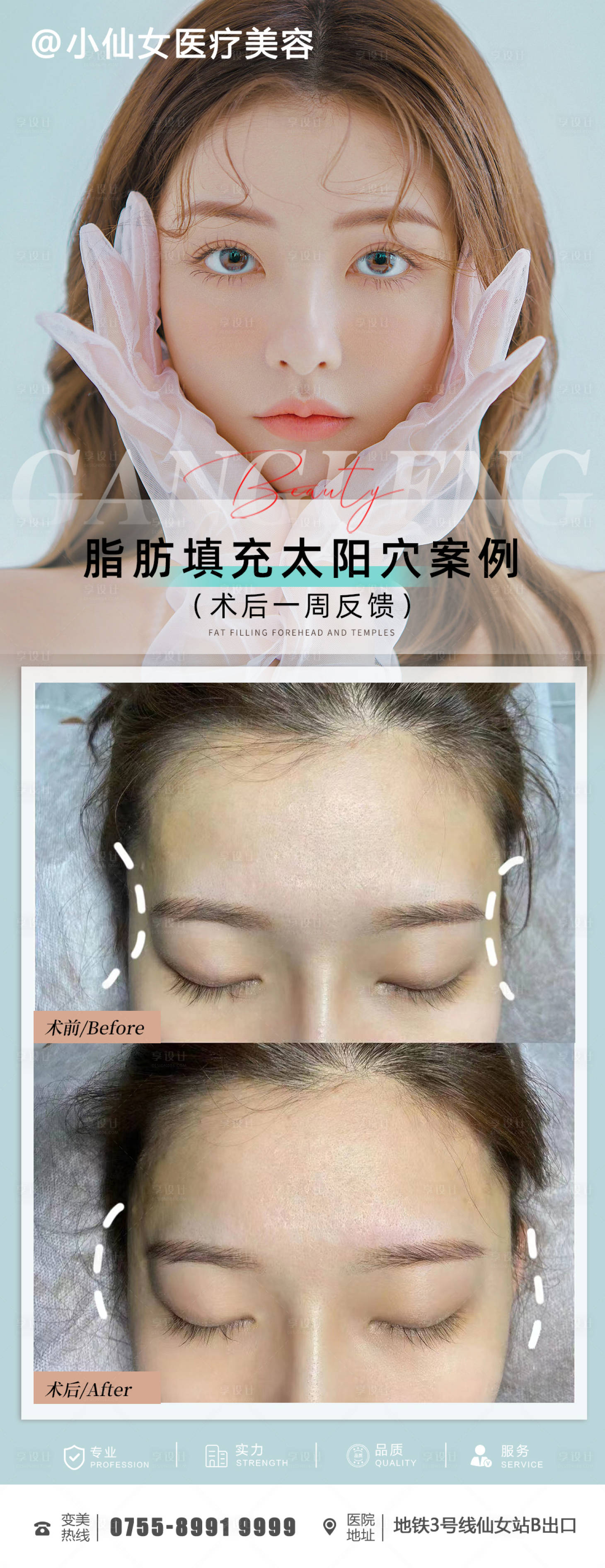 源文件下载【医美整形太阳穴案例】编号：40600011996202966