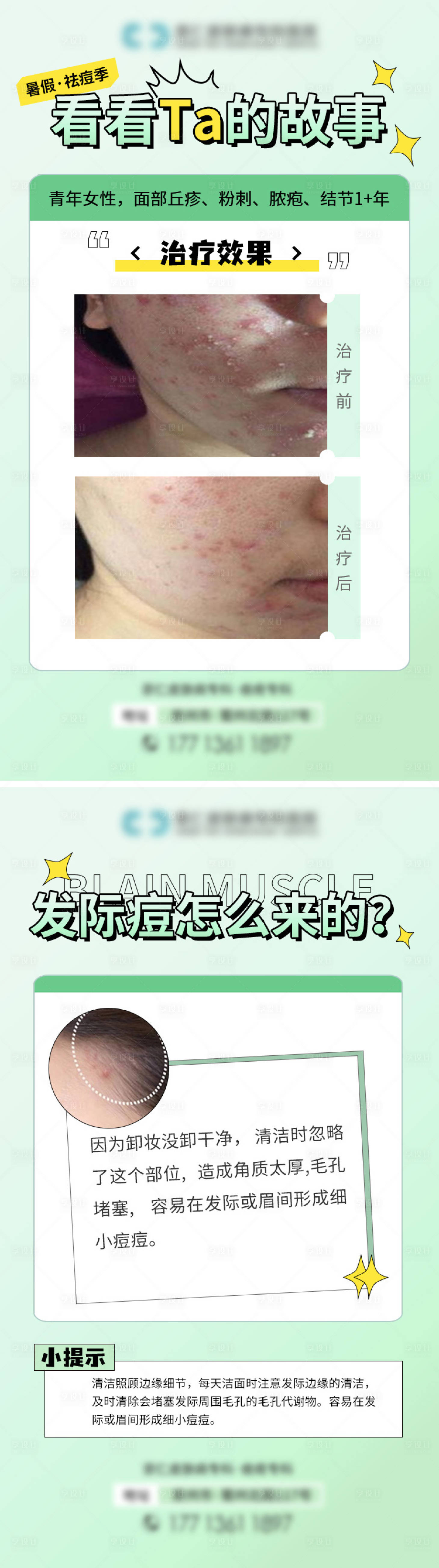 源文件下载【享设计】搜索编号：72790012030023880【祛痘科普案例海报】
