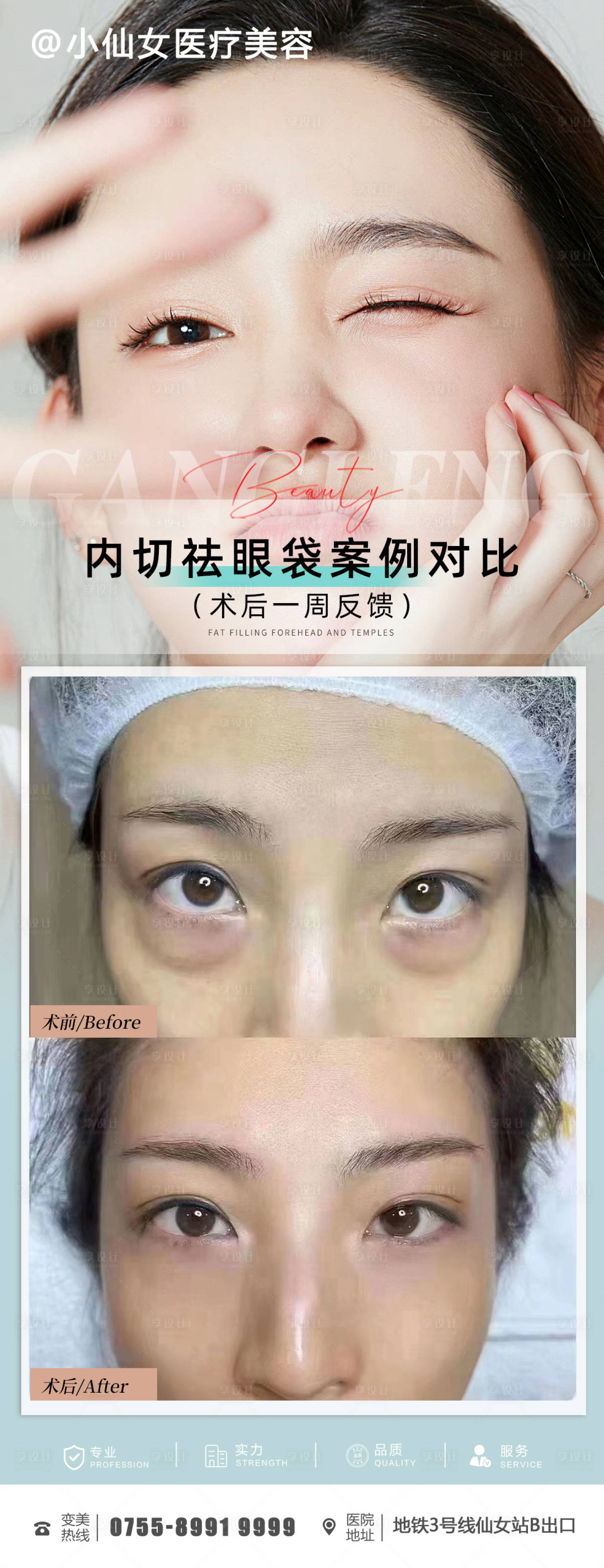 源文件下载【医美整形祛眼袋案例海报】编号：90970012294222556