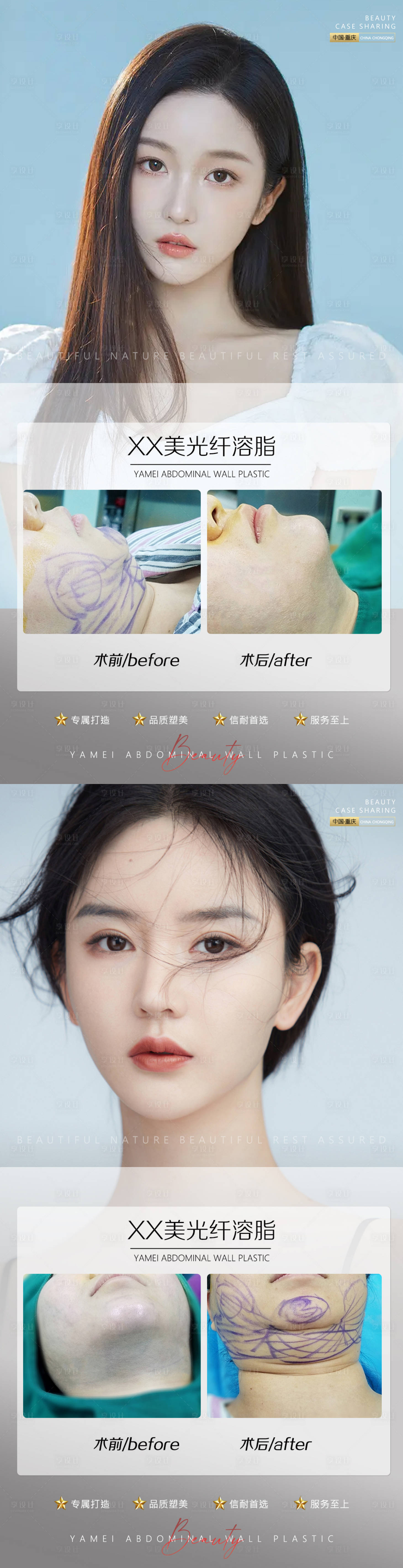 源文件下载【医美案例光纤溶脂海报】编号：91250012081599060