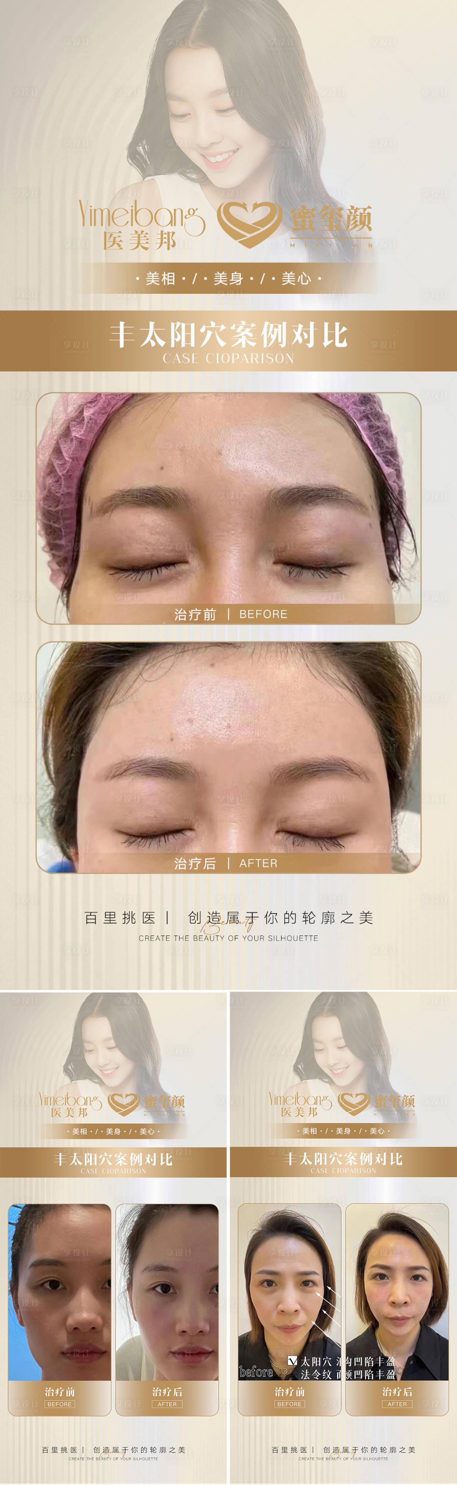 源文件下载【享设计】搜索编号：29980012494329105【医美丰太阳穴案例对比18组】