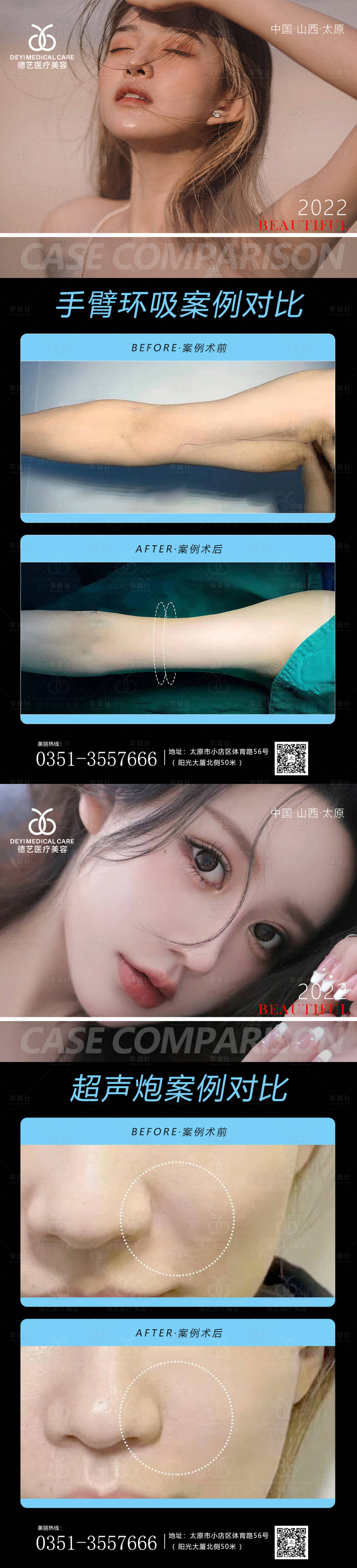 源文件下载【医美案例对比手臂环吸超声炮海报】编号：31930012998339591