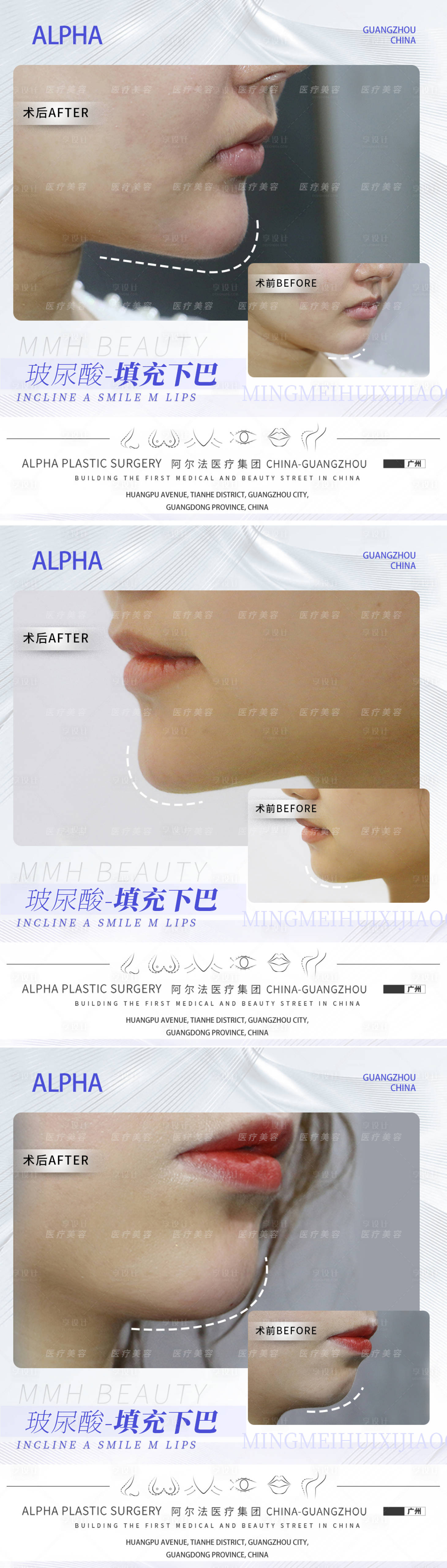 源文件下载【享设计】搜索编号：35380012949876230【医美玻尿酸案例海报】