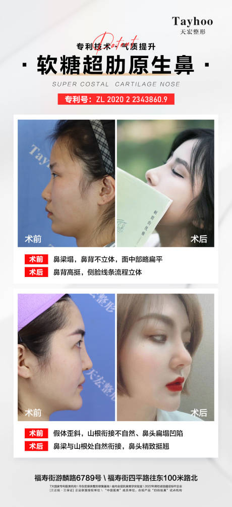 源文件下载【医美整形模特案例鼻整形超肋】编号：72810012517074828