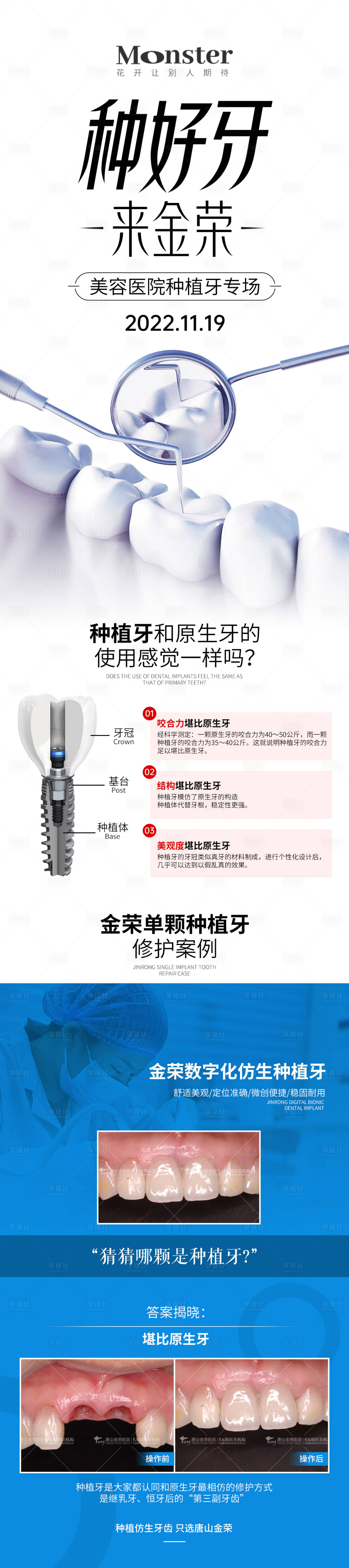 源文件下载【医美种植牙专题】编号：33540013622673758