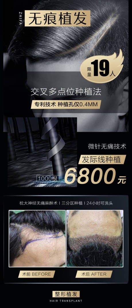 源文件下载【医美植发案例朋友圈海报】编号：67740013289891570
