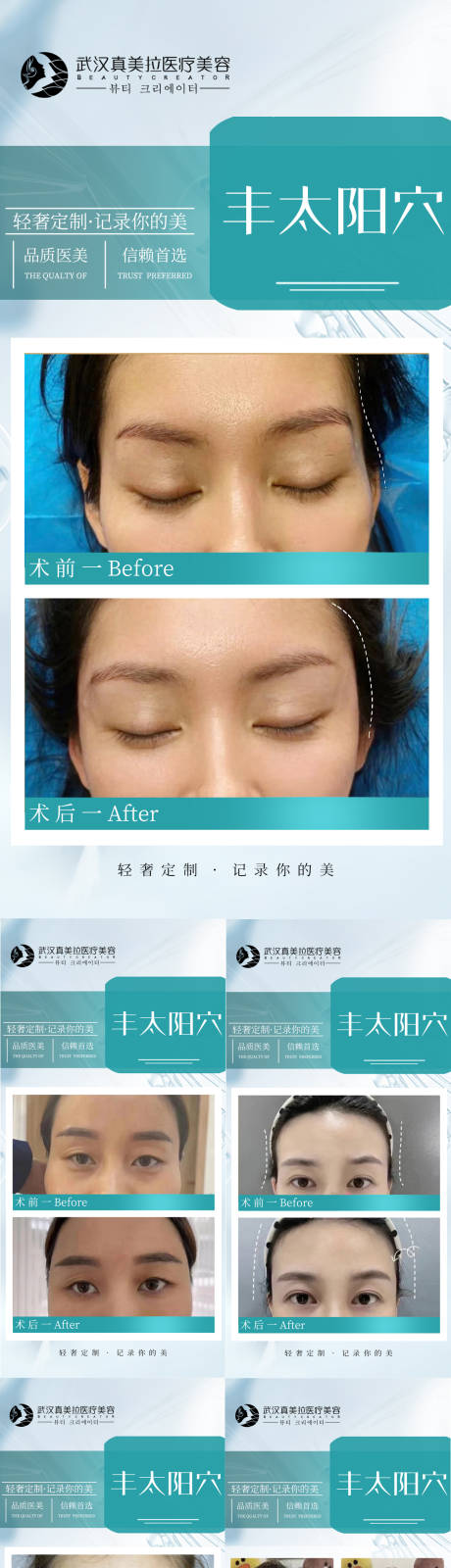 源文件下載【享設計】搜索編號：51310013277774434【醫美豐太陽穴案例對比海報】