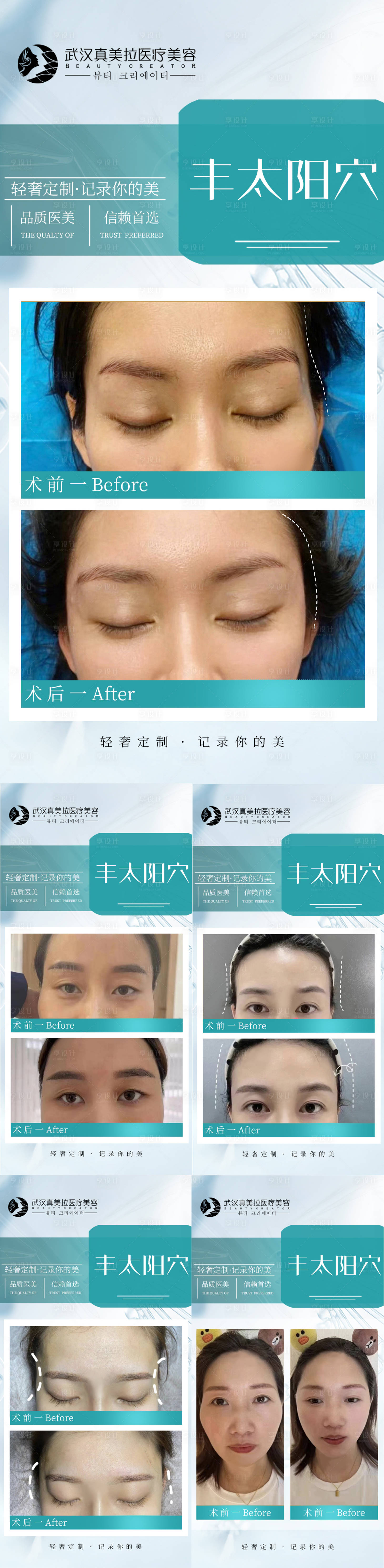 源文件下载【享设计】搜索编号：51310013277774434【医美丰太阳穴案例对比海报】