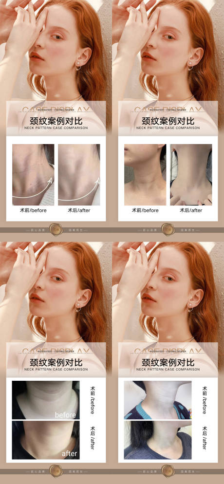 源文件下載【醫(yī)美去頸紋案例對比海報】編號：68630013667018686
