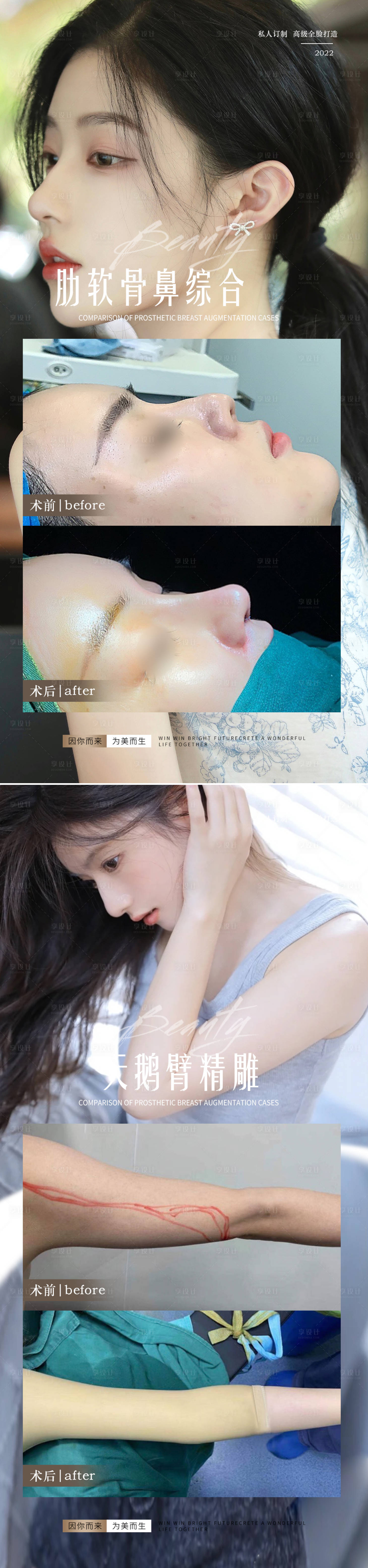 源文件下載【醫(yī)美隆鼻吸脂整形案例系列海報】編號：33450013766339213