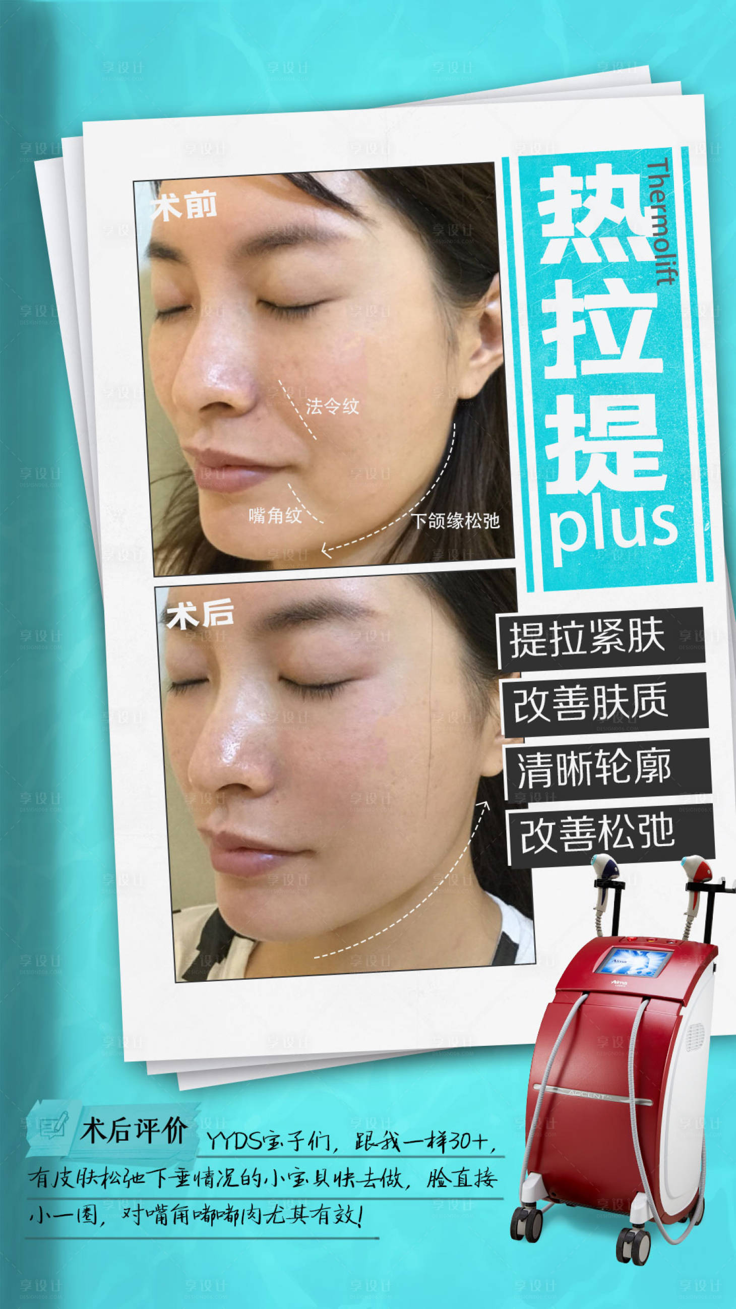 源文件下載【享設(shè)計(jì)】搜索編號(hào)：61870014024838331【熱拉提抗衰案例海報(bào)】