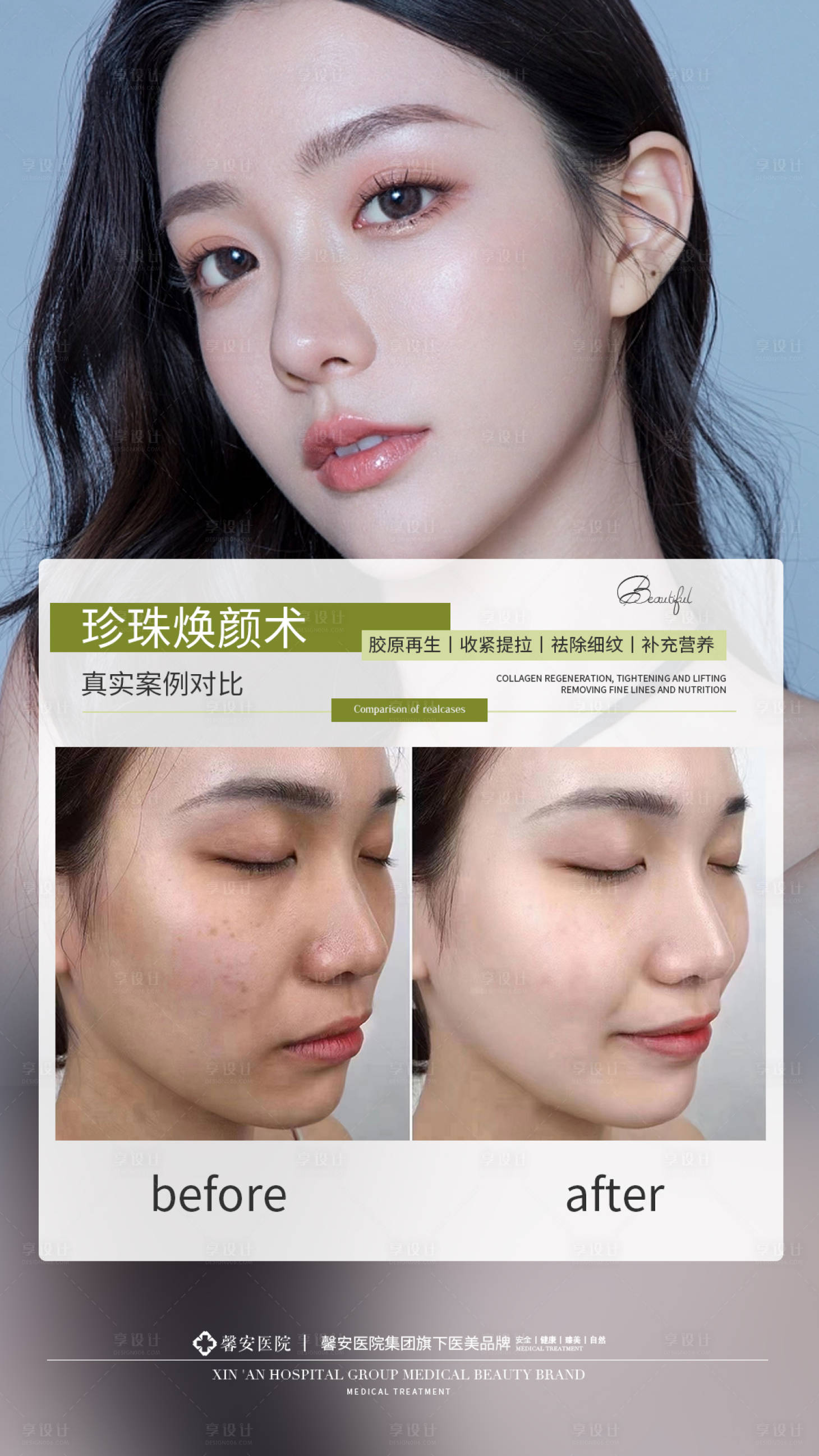 源文件下载【享设计】搜索编号：80980014812635580【医美水光针案例对比图海报】