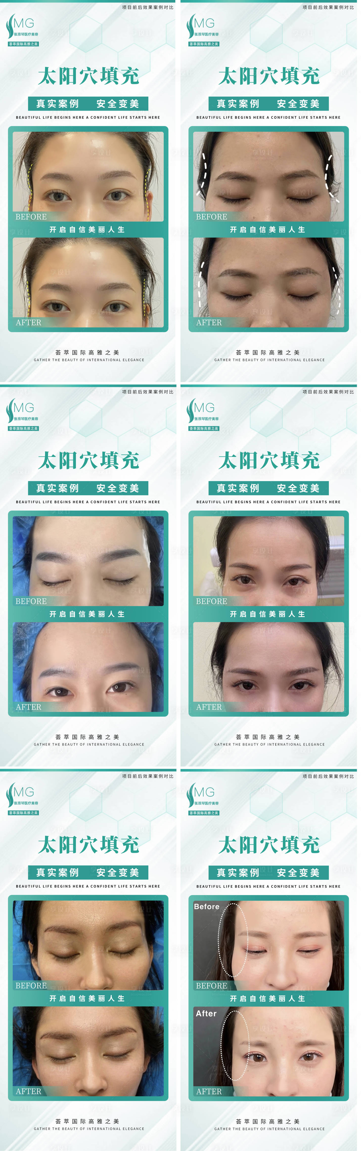 源文件下載【享設計】搜索編號：67310014503084075【醫美填充太陽穴6組案例對比】