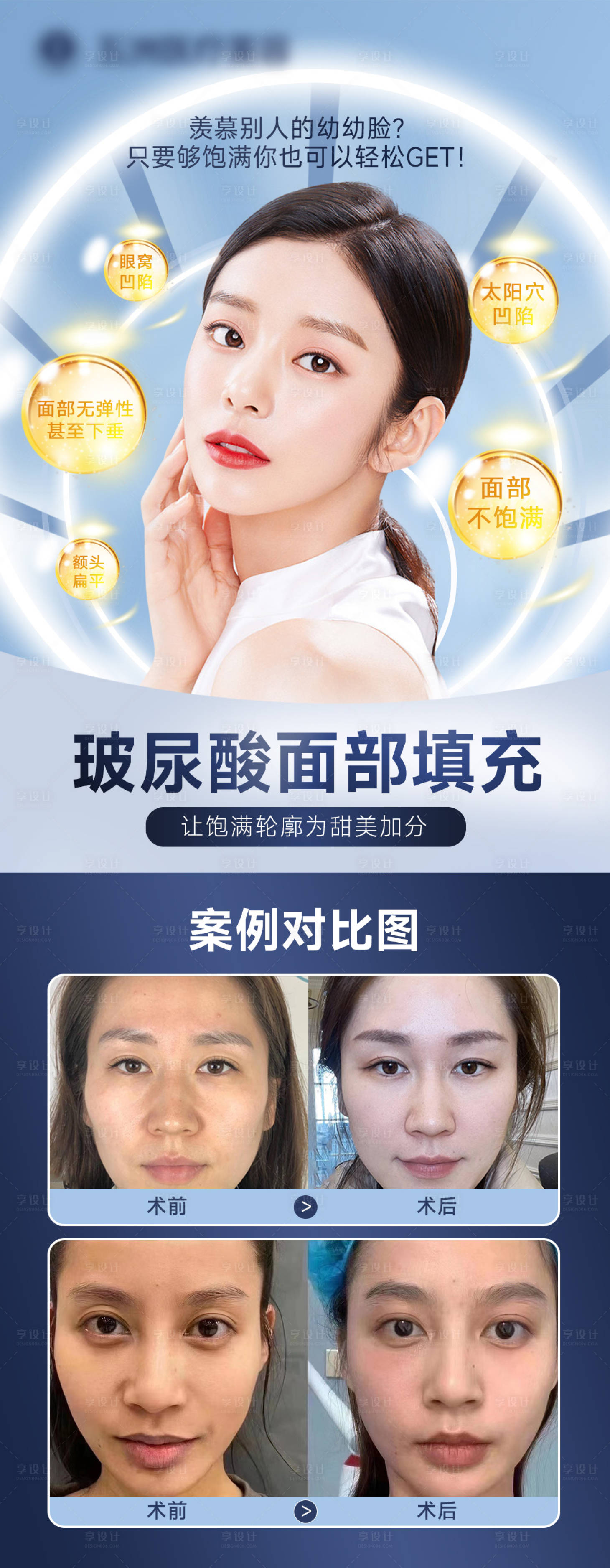 源文件下載【享設(shè)計(jì)】搜索編號：64010014537893302【玻尿酸案例海報(bào)】