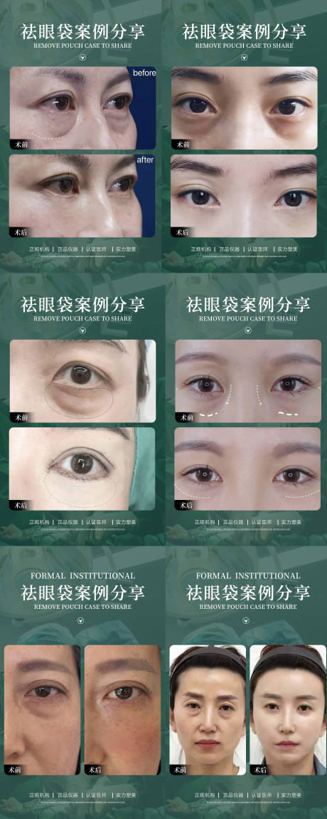 源文件下載【祛眼袋真人案例分享系列海報】編號：30150014672918100