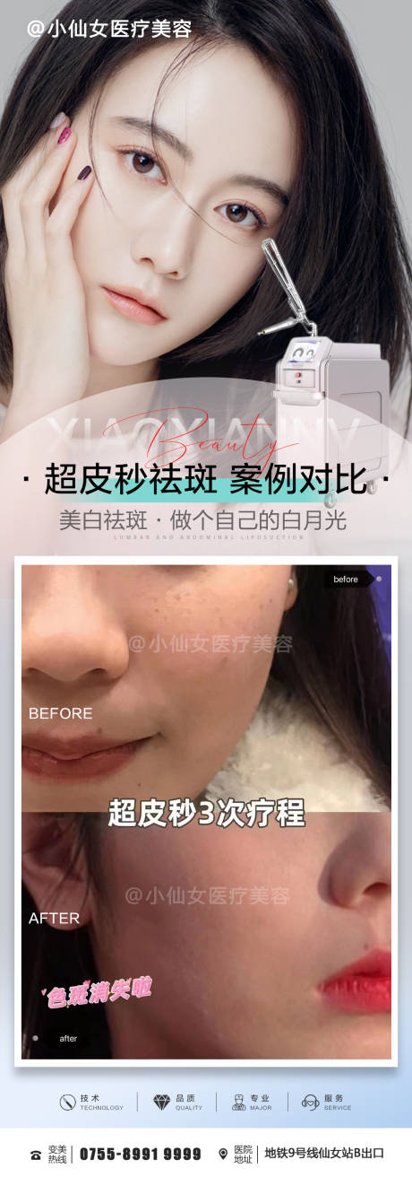 源文件下载【超皮秒祛斑案例对比海报】编号：82780015218474512