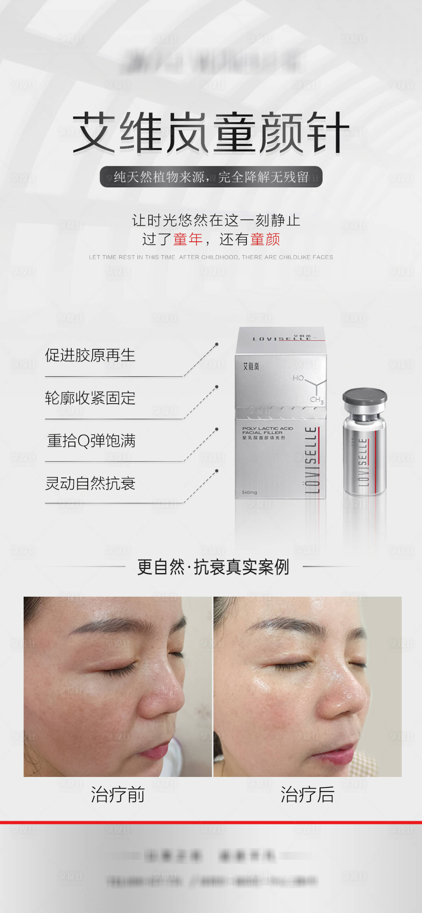 源文件下载【享设计】搜索编号：94350015095663397【艾维岚童颜针案例宣传海报】