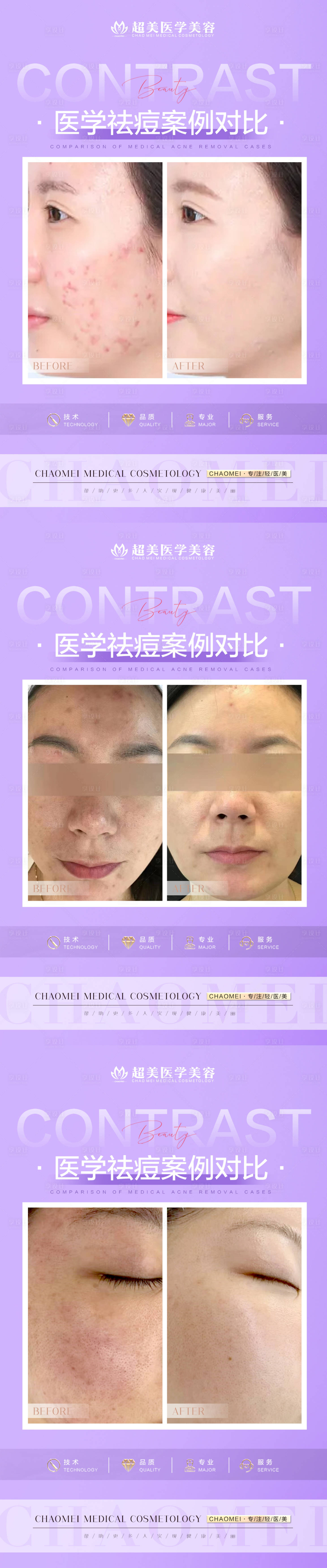 源文件下載【享設計】搜索編號：68800015380707521【祛痘案例對比海報】