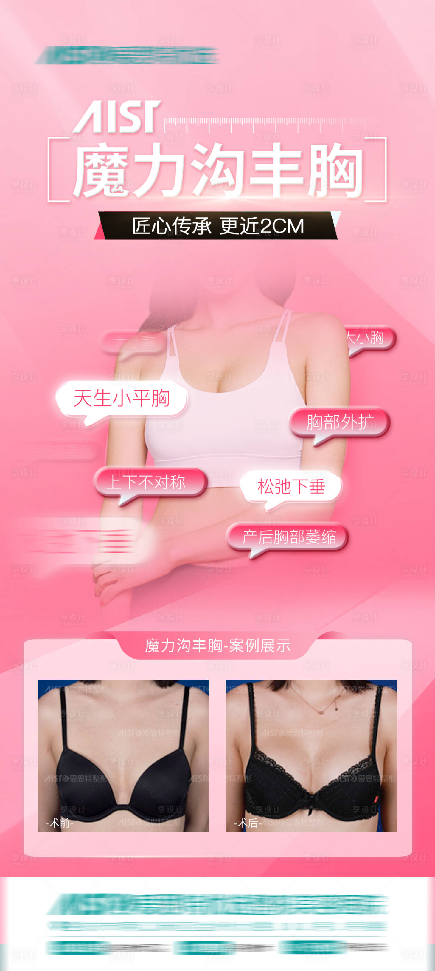 源文件下載【享設計】搜索編號：10190015401688932【隆胸案例海報】