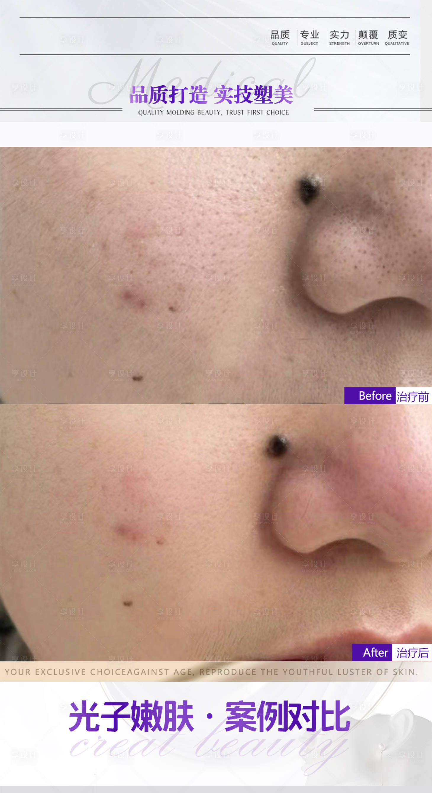 源文件下载【享设计】搜索编号：29850015615001717【光子嫩肤案例】